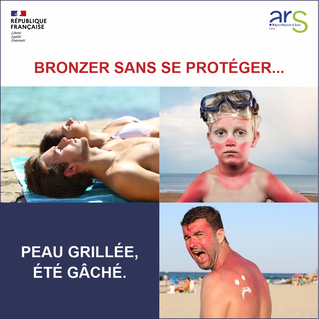 coup de soleil