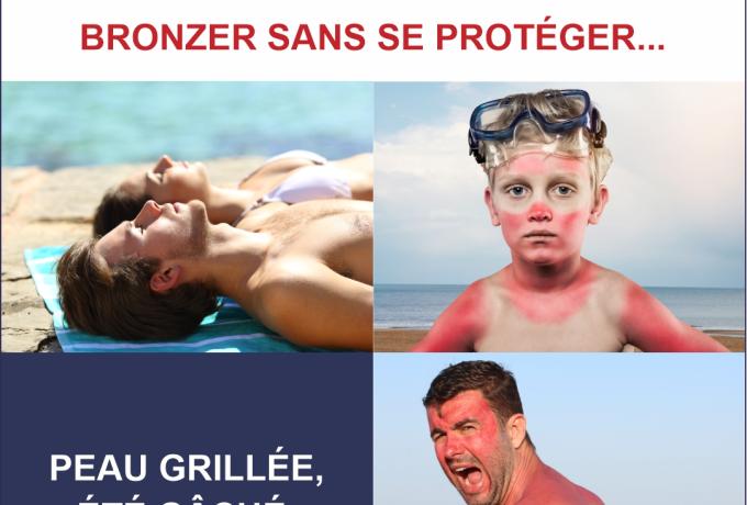 coup de soleil
